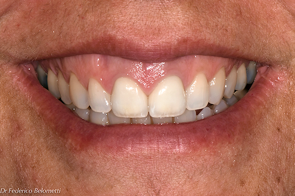 Nella visuale allargata al sorriso, possiamo osservare come i margini incisali degli elementi dentali disegnino una curva armonica e gradevole.