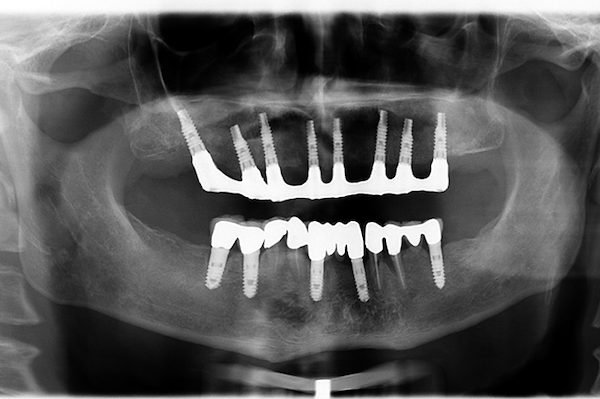 OPT – Esecuzione di 8 impianti con posizionamento dei denti in 24 ore dopo l’intervento (Implantologia a carico immediato)