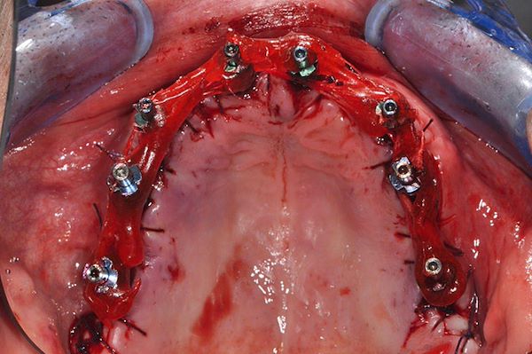 Posizionamento dei transfer per la presa delle impronte necessarie per la ricostruzione dei denti. L’impronta viene eseguita subito al termine dell’intervento.