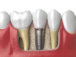 Per chi è indicata l’implantologia dentale?