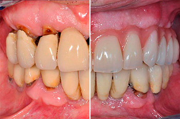 Implantologia dentale a carico immediato