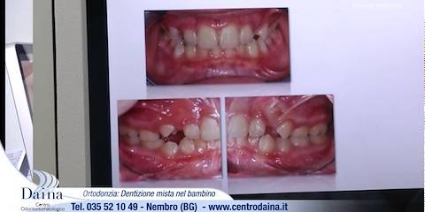 Dentizione mista nel bambino