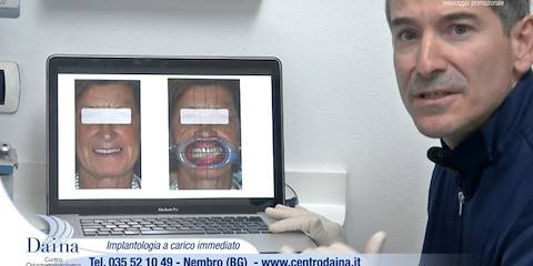 Implantologia a carico immediato