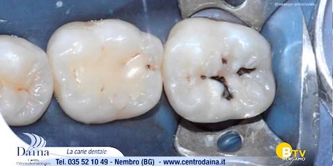 La carie dentale: come prevenirla e curarla