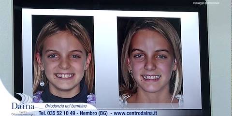 Ortodonzia nel bambino