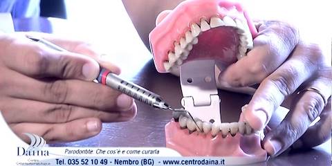 Paradontite: come curarla