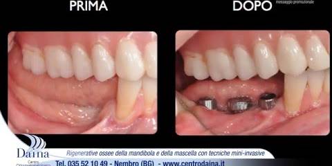 Rigenerativa ossee con tecniche mini invasive