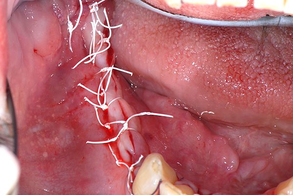 Sutura con sutura CYTOPLAST ® 3/0 con punti a materasso orizzontale intervallati da punti semplici