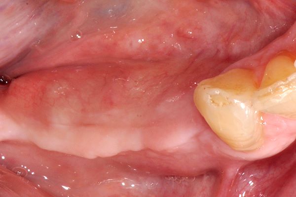 Visione occlusale pre-intervento della seconda chirurgia per rimozione membrana CYTOPLAST ® dopo 10 mesi dal primo intervento