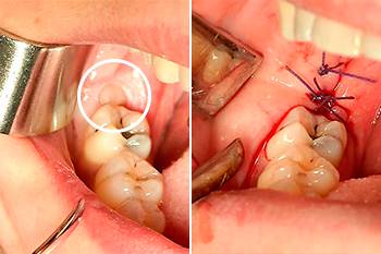 Avulsione dente del giudizio inferiore in inclusione ossea