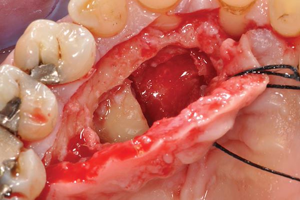 Odontotomia dell’elemento 23 per permettere l’estrazione