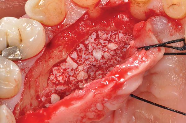 Posizionamento di biomateriale BIOSS nel sito post-estrattivo