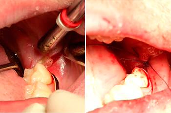 Estrazione dente del giudizio in inclusione ossea parziale con nervo alveolare tra le radici