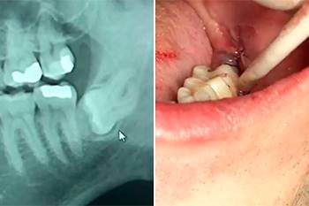 Estrazione dente del giudizio in inclusione ossea totale nel ramo mandibolare