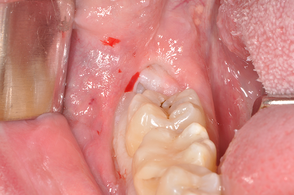Pre-intervento, ottavo inferiore (dente del giudizio) in inclusione ossea
