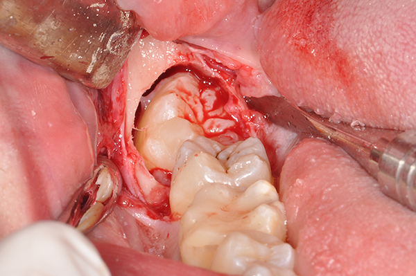 Esecuzione di ostectomia: si rimuove l’osso attorno al dente cercando la minor invasività possibile