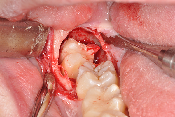 Odontotomia: separazione della corona e delle radici del dente