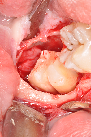 Odontotomia: separazione della corona e delle radici distali e mesiali   