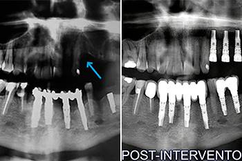 Grande rialzo e rigenerativa ossea verticale (GBR) con inserimento simultaneo di 2 impianti