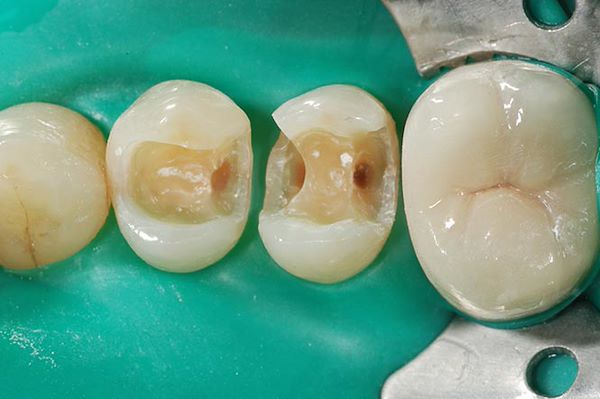 Rimozione delle vecchie otturazioni e del processo carioso sottostante