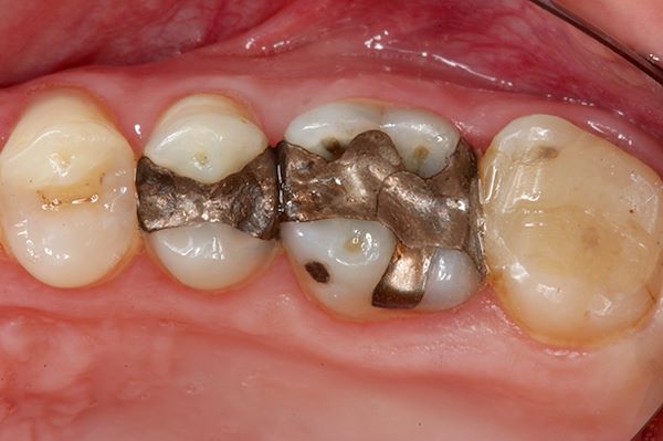 Presenza di otturazioni in amalgama infiltrate e fratturate