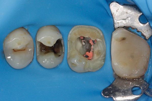 Rimozione del processo carioso ed esecuzione di terapia canalare a livello del molare