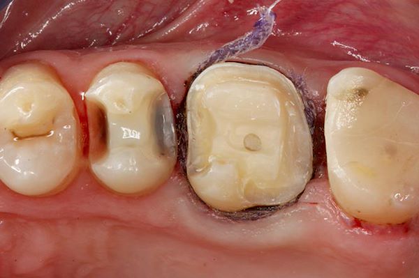 Condizionamento dei tessuti parodontali pre-impronta
