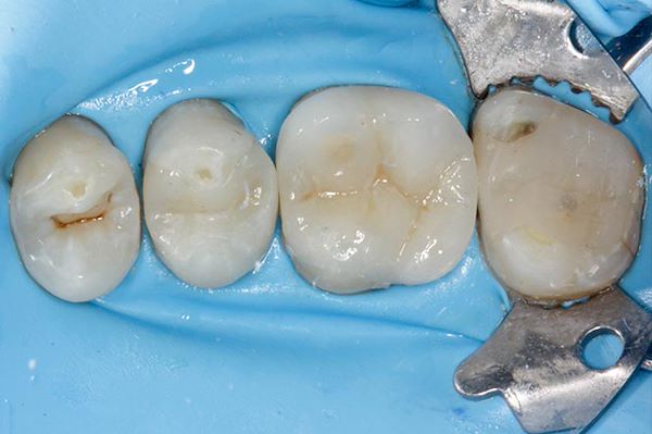 Cementazione dell’Onlay sul premolare e del Overlay sul molare, entrambi eseguiti in disilicato di litio