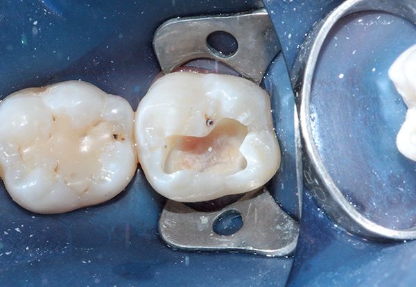 Detersione cavitaria: risulta evidente che la parete linguale dell’elemento non è adeguatamente sostenuta da dentina