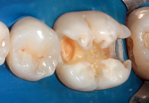 Preparazione cavitaria, con detersione contestuale della lesione cariosa mesiale del dente contiguo