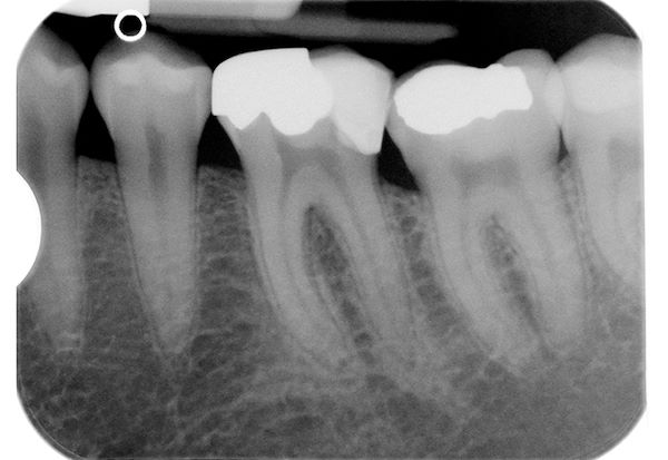 Rx 1: immagine pre-operatoria che rivela l’infiltrazione distale dell’otturazione pre-esistente responsabile dell’infiammazione pulpare