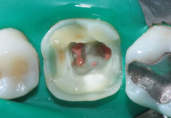 Elemento 36 gravemente compromesso, si può notare l’esiguità della struttura dentale sana residua a terapia canalare terminata