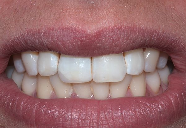 Elemento 11 dopo sbiancamento interno e ricostruzione diretta subito dopo la rimozione della diga di gomma (i denti appaiono disidratati)