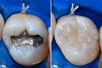 Rifacimento otturazione in amalgama