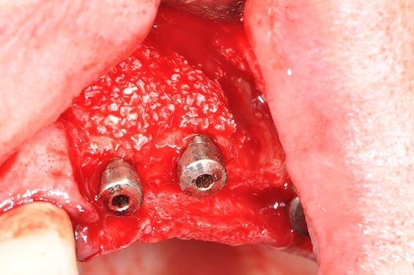 Inserimento di biomateriale BIOSS per aumentare volume osseo.