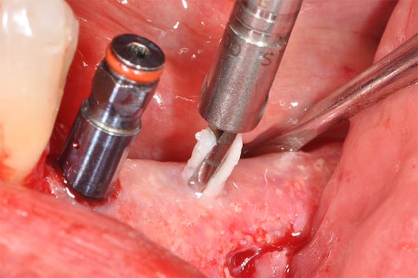 Fase intraoperatoria del posizionamento implantare: si noti la presenza d’osso sulla fresa indice di un’ottima densità e qualità d’osso necessaria per la stabilità primaria dell’impianto