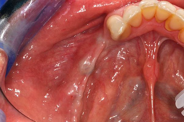 Visione occlusale dopo 3 mesi dal posizionamento implantare: si noti l’assenza di gengiva cheratinizzata, importante per la durata a lungo termine della salute implantare
