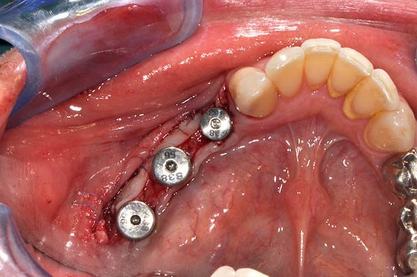 Sutura dell’innesto epitelio-connettivale e posizionamento delle viti di guarigione sugli impianti