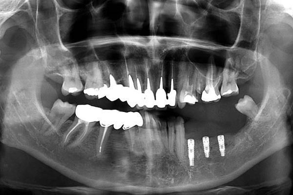 OPT con posizionamento implantare dopo 8 mesi dalla rigenerativa ossea
