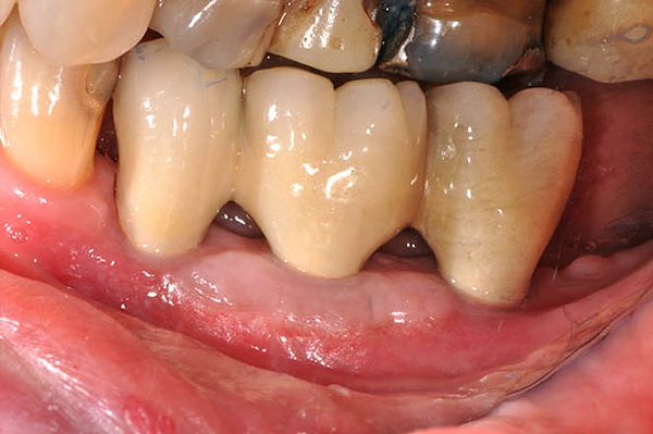 Visione laterale di denti in resina provvisori
