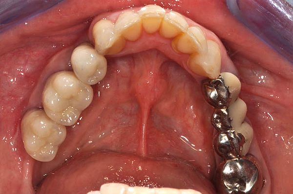 Visione occlusale di denti in resina provvisori
