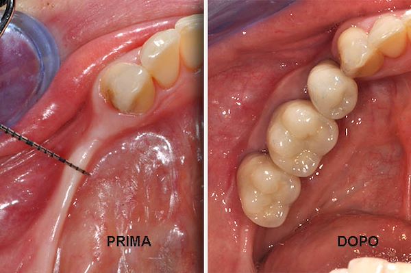 Prima della riabilitazione implanto protesica e risultato dopo 14 mesi con rigenerativa ossea, implantologia, rigenerativa mucogengivale e corone provvisorie