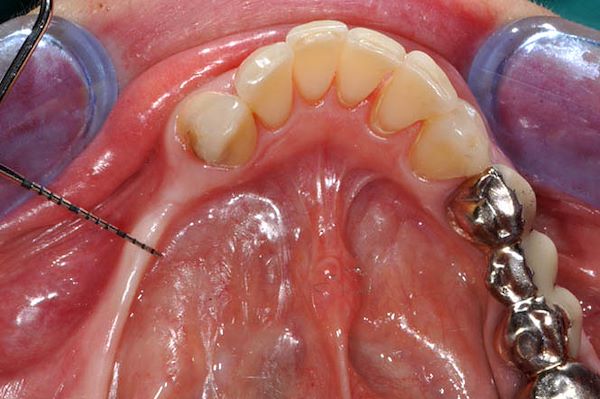 Visione occlusale dell’atrofia ossea (perdita d’osso) evidenziata dalla sonda parodontale calibrata