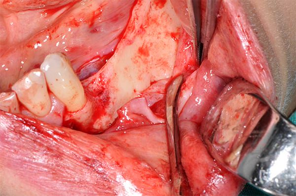 Visione intraoperatoria laterale: si noti osso “lama di coltello” (insufficienza di spessore osseo)