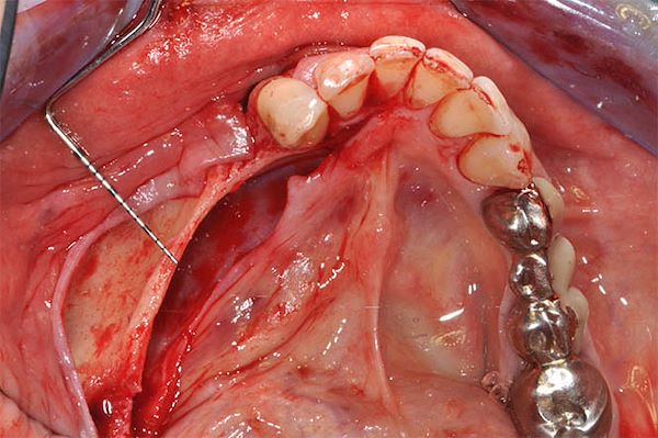 visione occlusale con posizionamento sonda parodontale che evidenzia uno spessore d’osso di 1 mm
