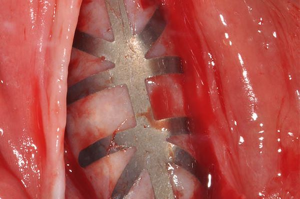 Incisione in cresta della gengiva ed esposizione della membrana non riassorbibile Gore rinforzata in titanio