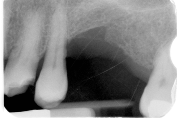 RX pre-operatoria: perdita ossea verticale