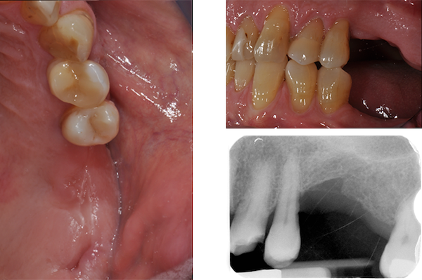 Visione occlusale e  vestibolare dell’atrofia ossea