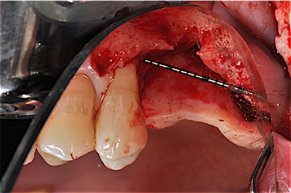 Volume osseo da rigenerare indicato con sonda parodontale posizionata tra i due picchi ossei