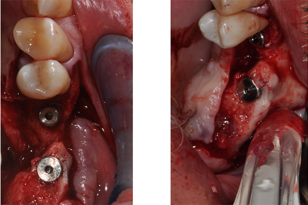 Posizionamento implantare Prelievo osseo mini-invasivo con “safescraper” (grattino da osso) monouso